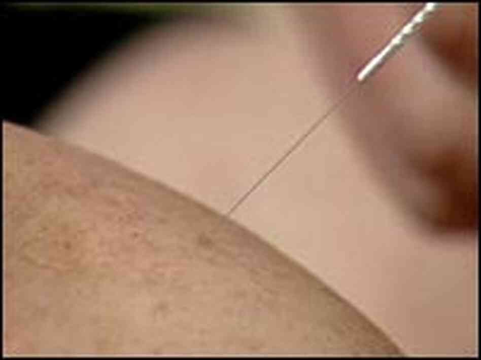 An acupuncture needle is used to treat knee osteoarthritis. An acupuncture needle is used to treat knee osteoarthritis.