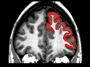 An image of the brain with the frontal lobe highlighted