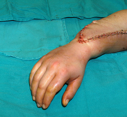 Savage's new hand.