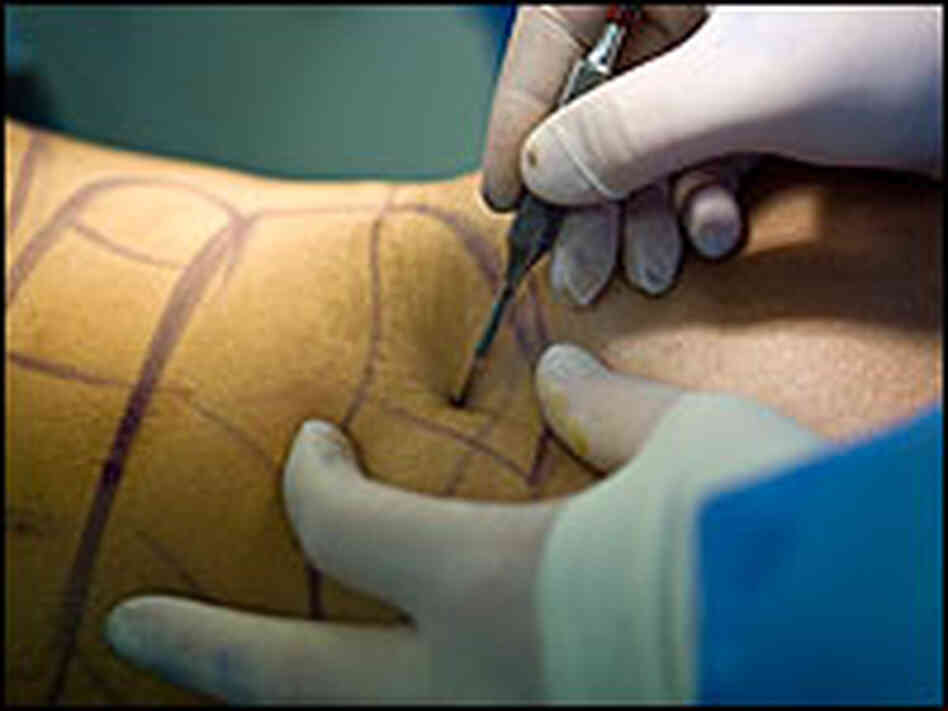 A doctor cuts with a scalpel in a liposuction surgery.