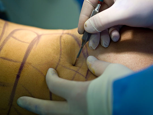 A doctor cuts with a scalpel in a liposuction surgery.