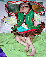 A malnourished baby lies in an Afghan hospital