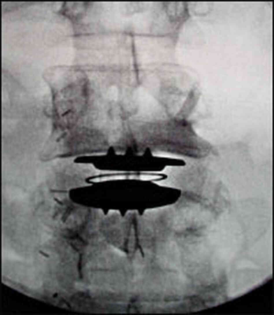An X-ray reveals the Charite artificial disc implanted in a patient's spine. An X-ray reveals the Charite artificial disc implanted in a patient's spine.