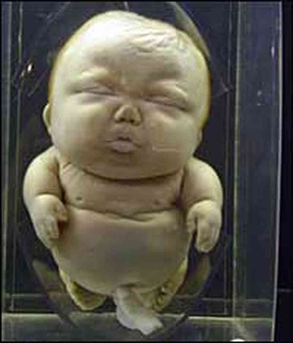 The Museum collection includes this preserved example of Achondroplastic dwarfism. The Museum collection includes this preserved example of Achondroplastic dwarfism.