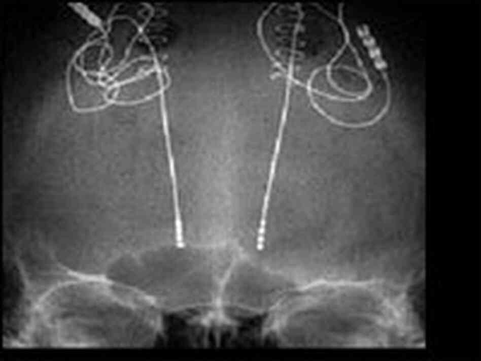 An X-ray shows deep brain stimulation electrodes implanted in the brain of a patient. An X-ray shows deep brain stimulation electrodes implanted in the brain of a patient.
