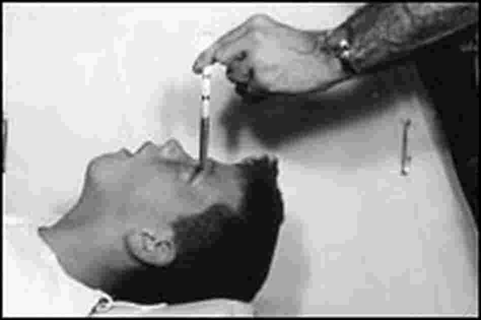 Howard Dully during his transorbital lobotomy, Dec. 16, 1960. Howard Dully during his transorbital lobotomy, Dec. 16, 1960.