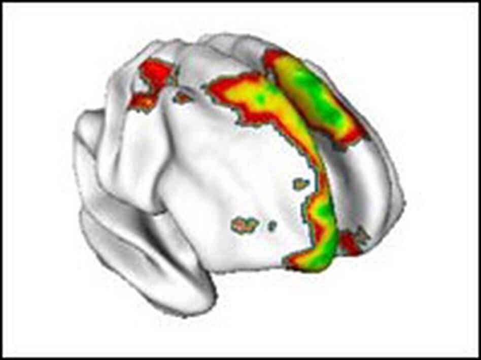 MRI of the brain's gray matter. MRI of the brain's gray matter.