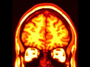 coronal MRI
