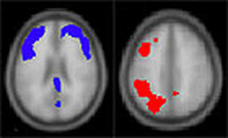 Brain scans comparing the effects of talk therapy vs. drug therapy. Brain scans comparing the effects of talk therapy vs. drug therapy.