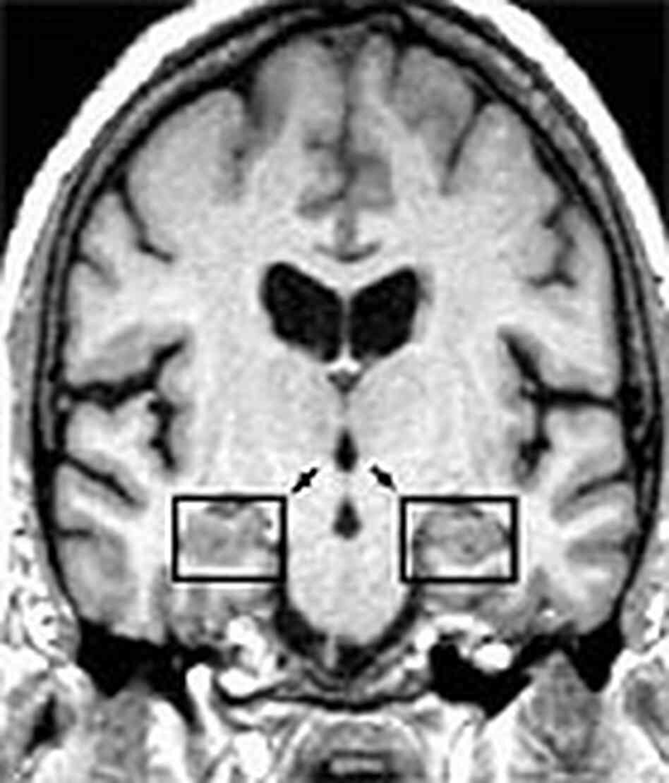 Brain scan with hippocampus marked. Brain scan with hippocampus marked.