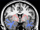 This MRI shows regions where white matter volumes were significantly reduced in boys born preterm. This MRI shows regions where white matter volumes were significantly reduced in boys born preterm.