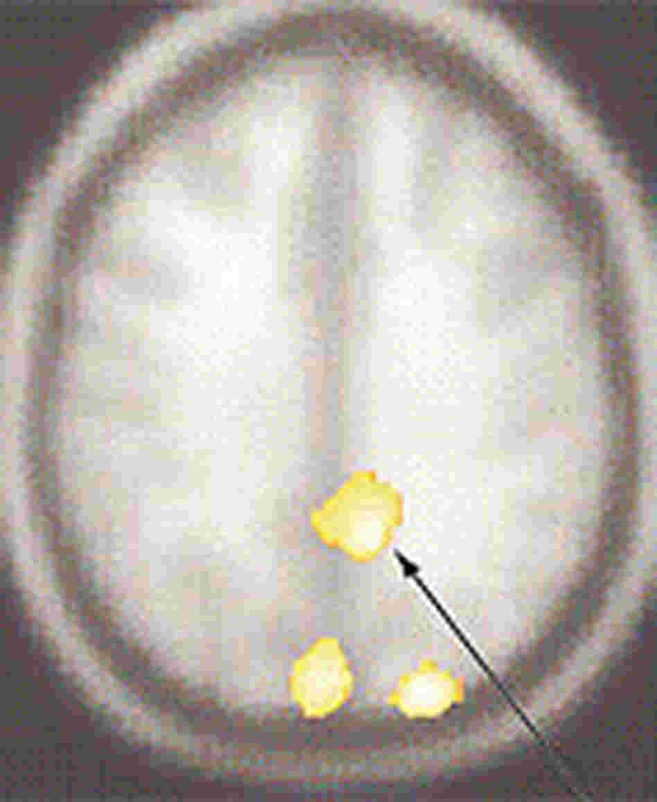 A scan of the human brain shows areas that had significantly lower activity in compulsive hoarders A scan of the human brain shows areas that had significantly lower activity in compulsive hoarders