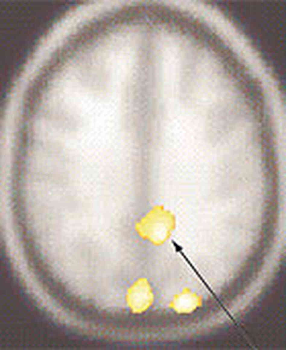 A scan of the human brain shows areas that had significantly lower activity in compulsive hoarders A scan of the human brain shows areas that had significantly lower activity in compulsive hoarders