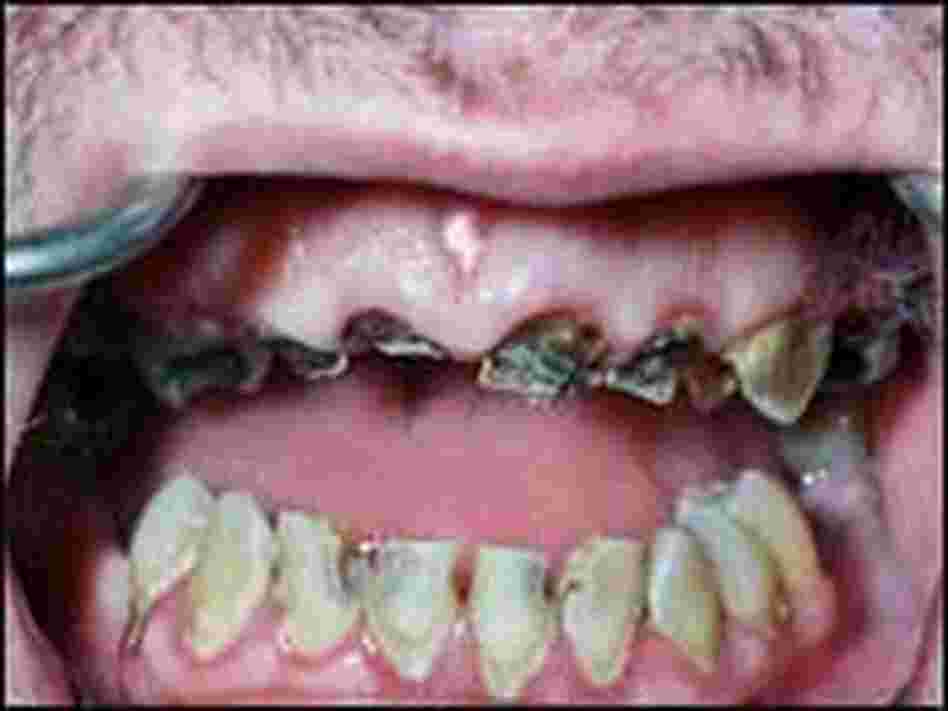 A photo from Dr. Heringlake's collection of "meth mouth" patients. A photo from Dr. Heringlake's collection of "meth mouth" patients.