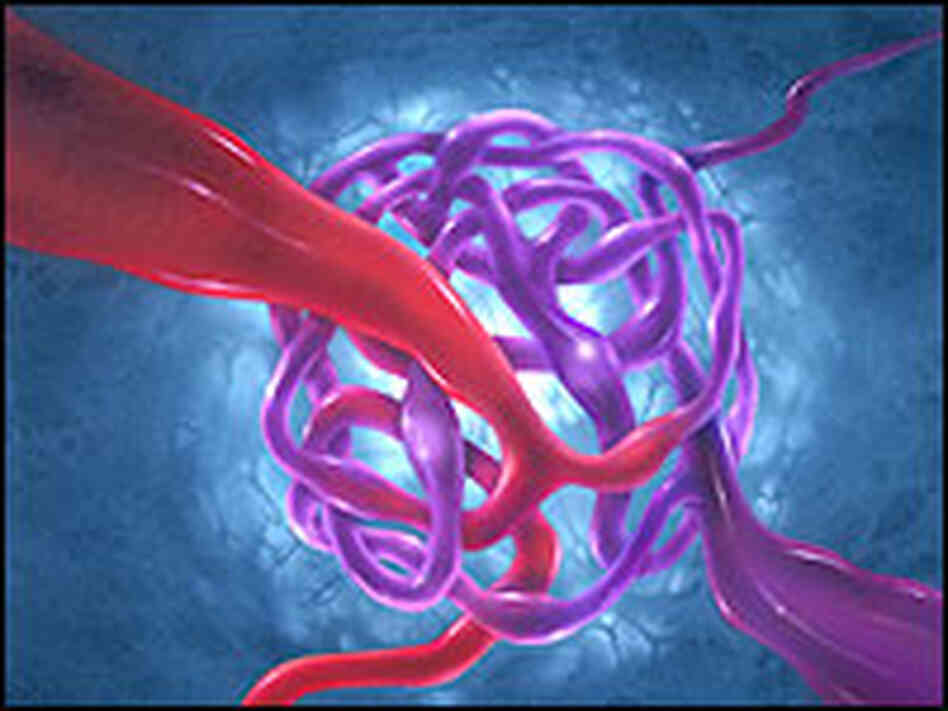 An illustration depicting an arteriovenous malformation. An illustration depicting an arteriovenous malformation.
