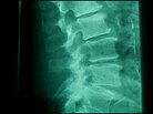 X-ray of the lower spine. X-ray of the lower spine.