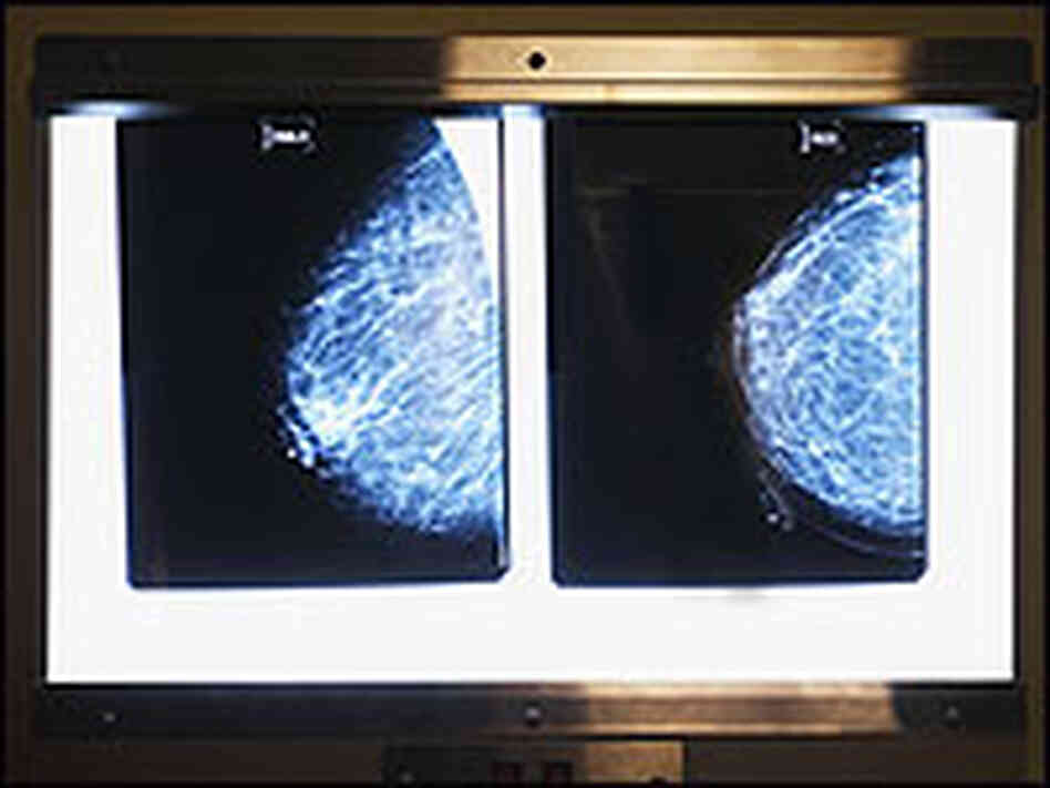 A digital mammography X-ray. A digital mammography X-ray.