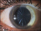 Incisions from an RK surgery radiate out from the center of the eye. Incisions from an RK surgery radiate out from the center of the eye.