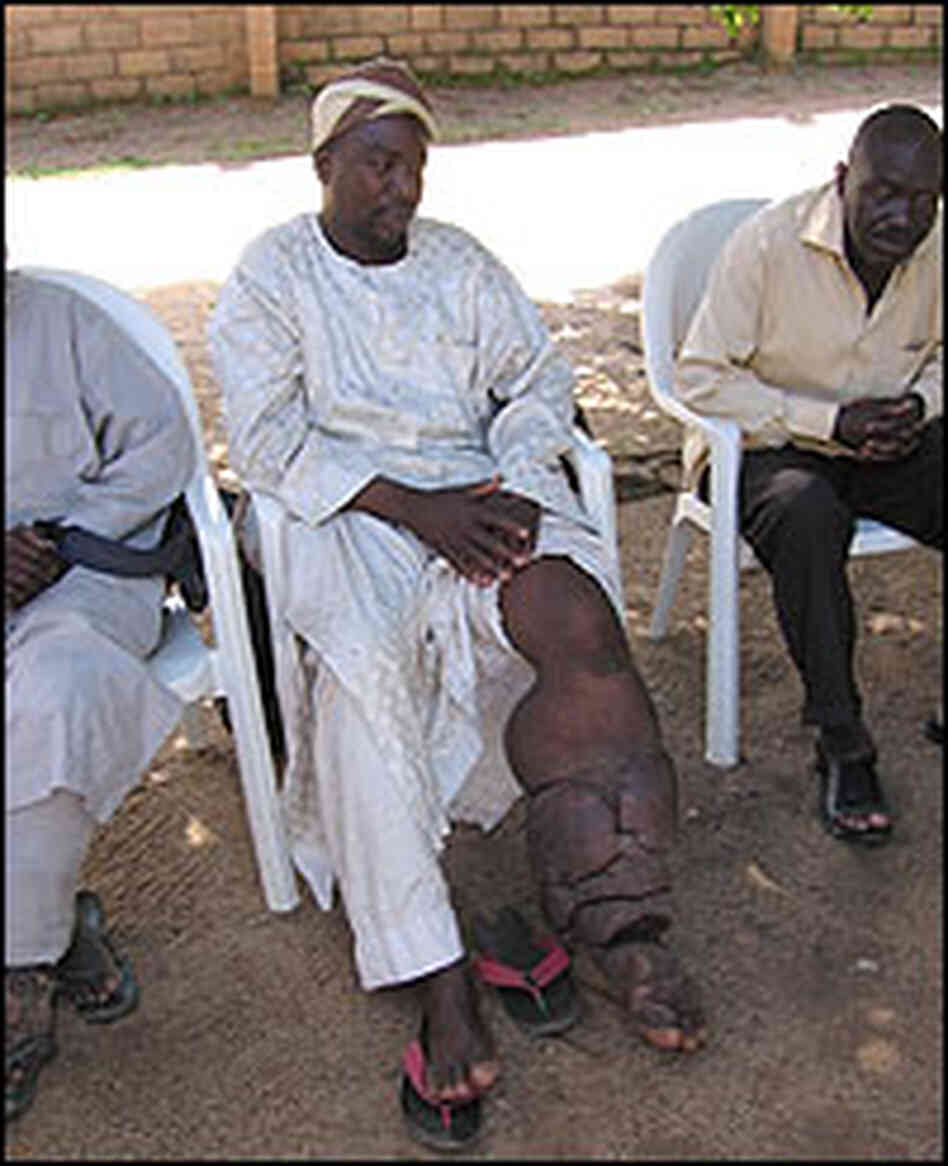 Hamisu Isa's leg is swollen by lymphatic filariasis. Hamisu Isa's leg is swollen by lymphatic filariasis.