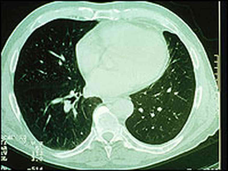 A CT scan of lungs. A CT scan of lungs.