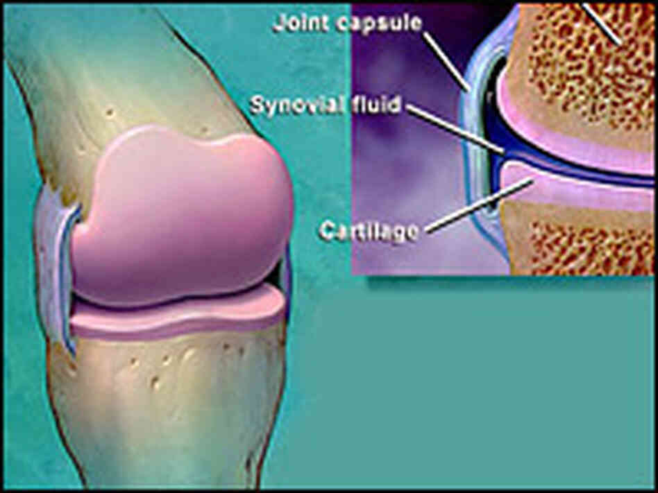 Click to see how the joint degenerates when osteoarthritis sets in.