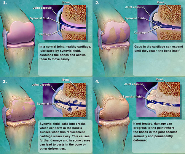 Click to see how the joint degenerates when osteoarthritis sets in.