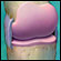 A healthy knee joint. Courtesy Medco Health