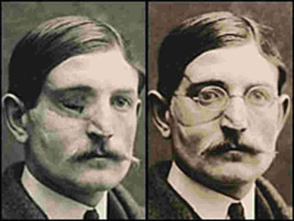 World War I Disfigure Masks World War I Disfigure Masks