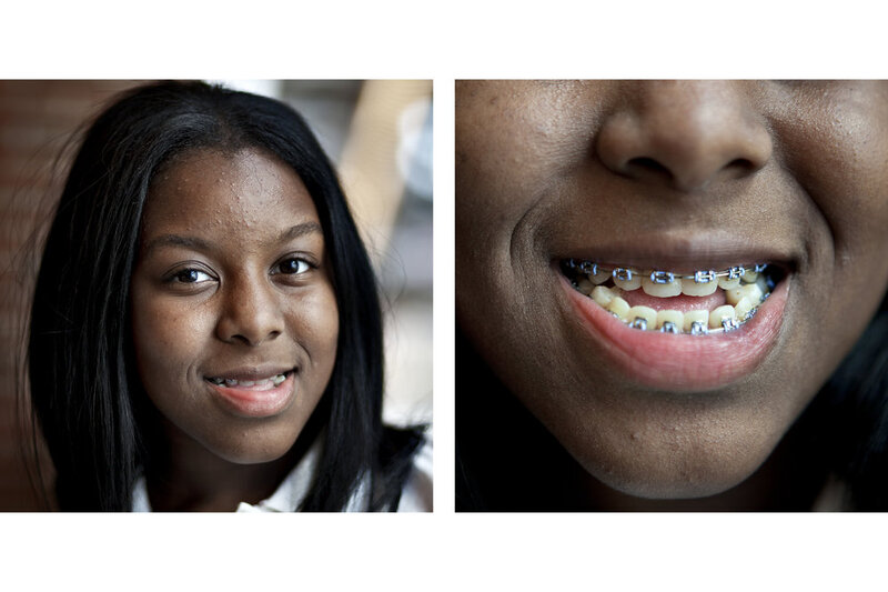Braces For Young Kids Might Not Always Be Best NPR