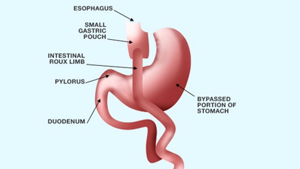 Fat State Stretched Thin Tennessee Covers Gastric Bypass NPR