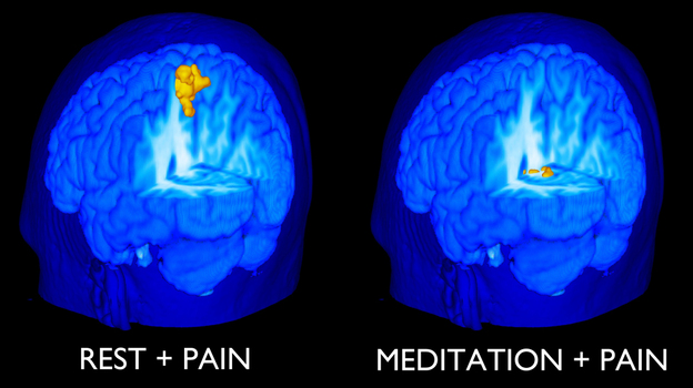 Signs of pain disappeared from MRI images of the brain when freshly trained novices meditated. Signs of pain disappeared from MRI images of the brain when freshly trained novices meditated.