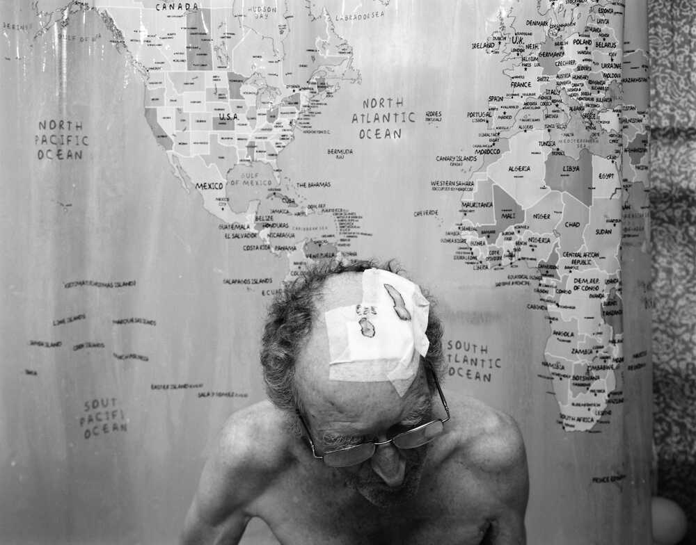 Bob Hardman's shaved head is scarred from where a deep brain stimulator was implanted.