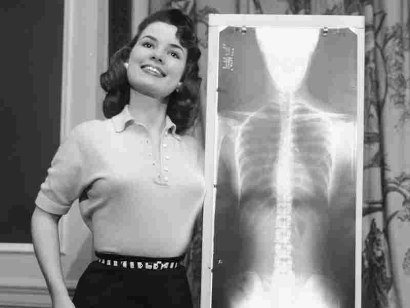 Lois Conway, Miss Correct Posture for 1956, stands tall next to an X-ray of her spine at a chiropractor-judged beauty contest held in Chicago.