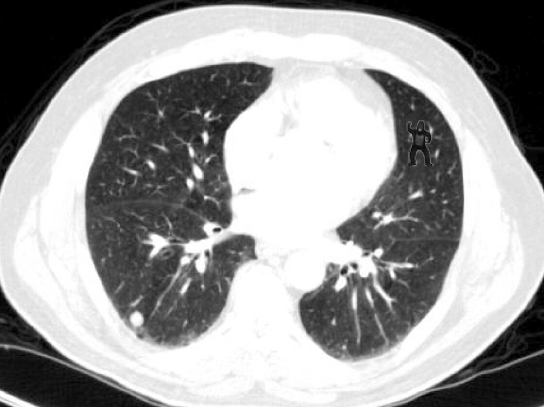 Notice anything unusual about this lung scan? Harvard researchers found that 83 percent of radiologists didn't notice the gorilla in the top right portion of this image.