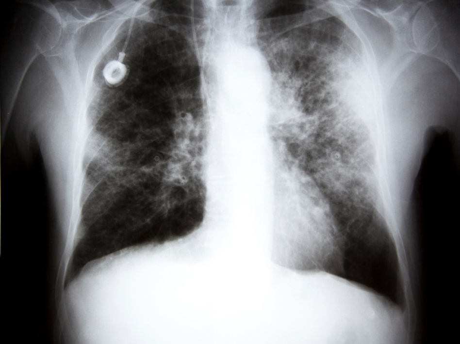 Some images of lung cancer are clear cut. But in many others, a nodule on the screen turns out not to be cancer at all. (iStockphoto.com)