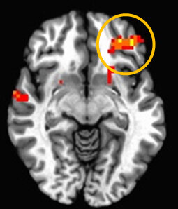 Brain Imaging Studies Seek Signs Of >> The Case Against Brain Scans As Evidence In Court Shots Health Brain Imaging Studies Seek Signs Of >> The Case Against Brain Scans As Evidence In Court Shots Health