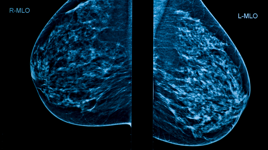 Mammograms are a key screening tool for breast cancer. But critics say they're not good enough. (iStockphoto)