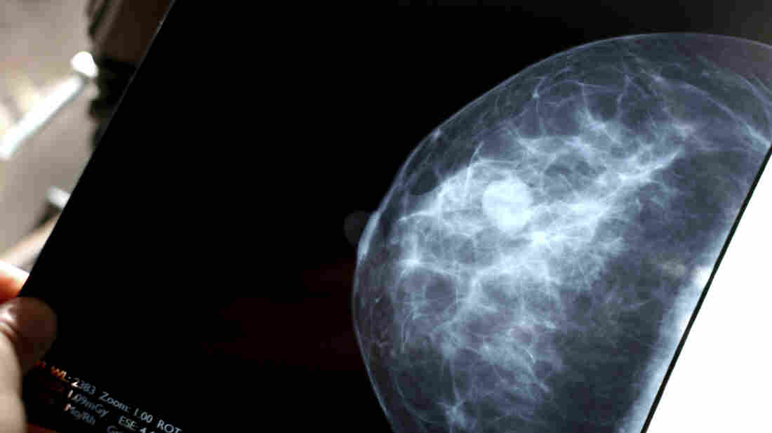 A mammogram.
