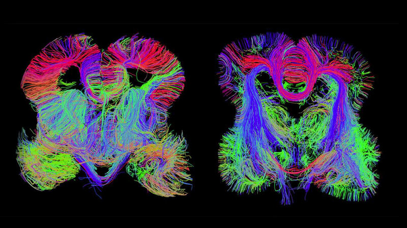 Brain Tissue Reveals More Genetic Clues >> Map Of The Developing Human Brain Shows Where Problems Begin Shots Brain Tissue Reveals More Genetic Clues >> Map Of The Developing Human Brain Shows Where Problems Begin Shots
