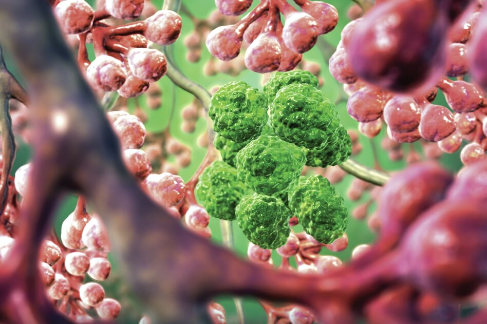 An artist's illustration shows lung cancer cells lurking among healthy air sacs. (David Mack/Science Source)