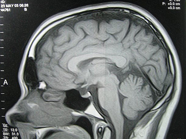 Chronic stress can cause deficiencies in the pre-frontal cortex, which is essential for learning. (Flickr)