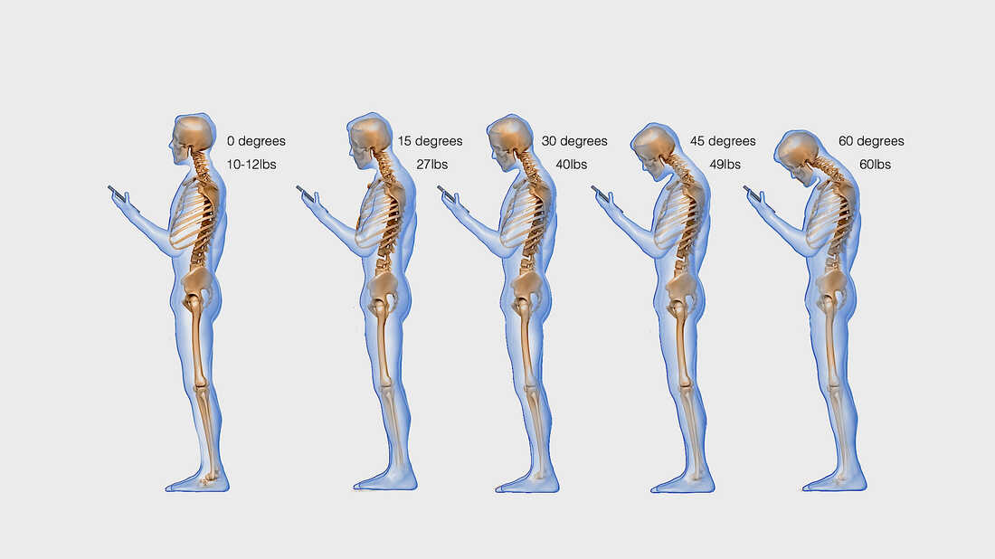 Why Good Posture Matters After Spinal Surgery - The Spine Institute  Foundation