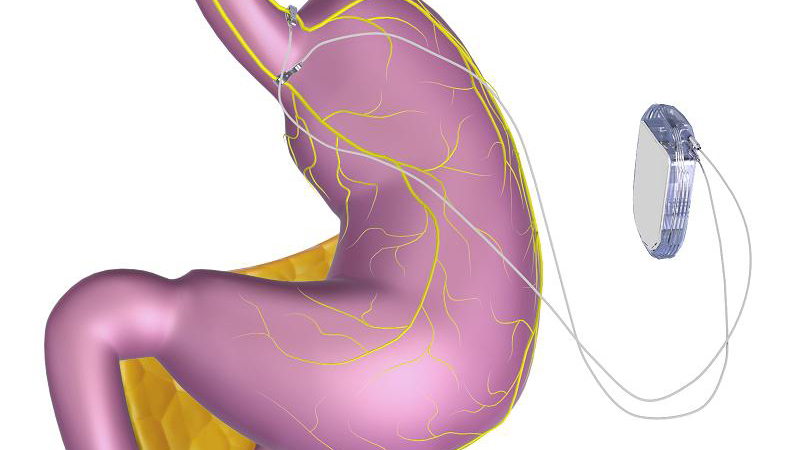 A Weight-Loss Device Aims To Curb Hunger By Zapping A Nerve : Shots ...