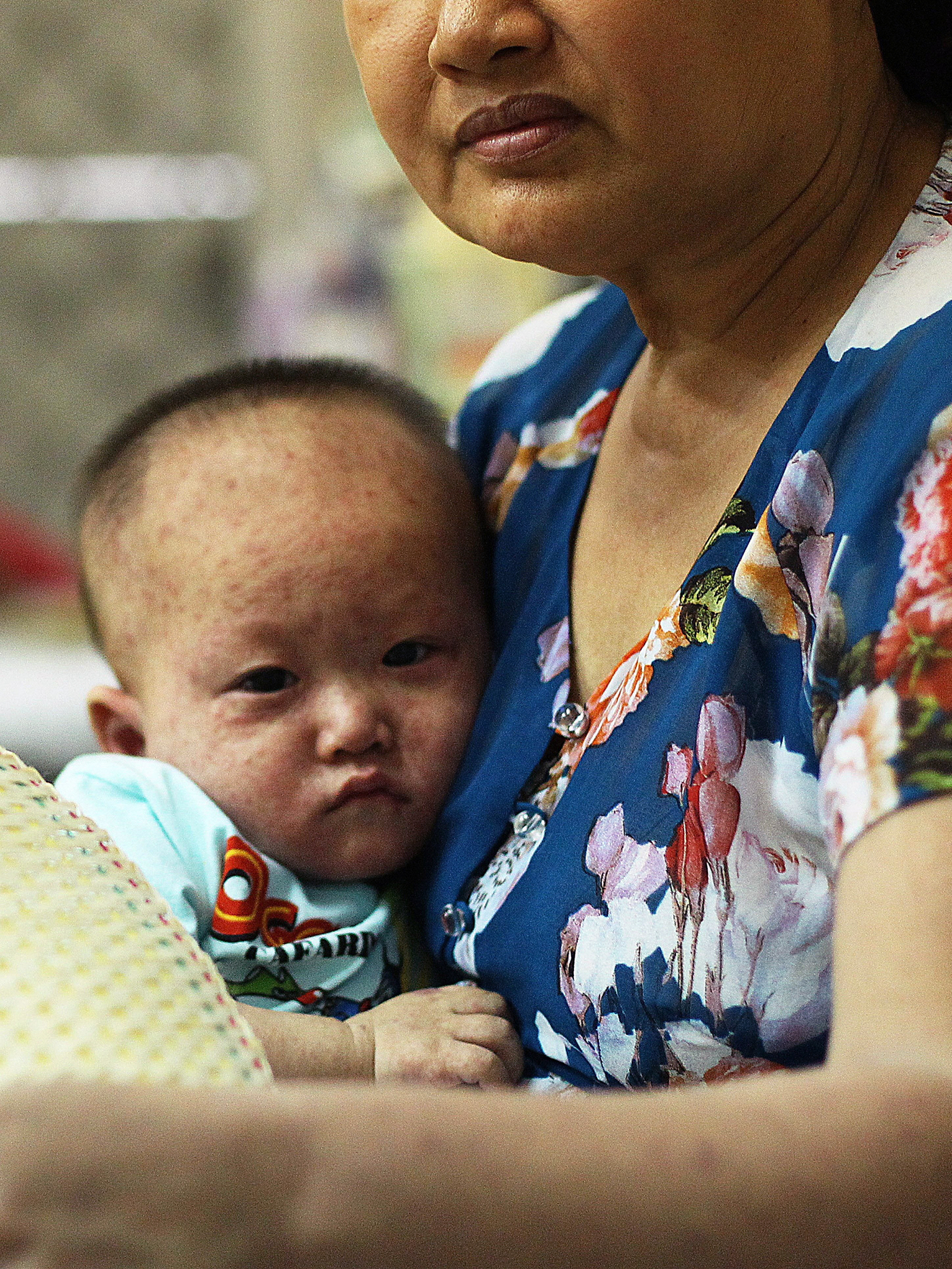 A Vietnamese boy is treated for measles in a state-run hospital in April 2014.