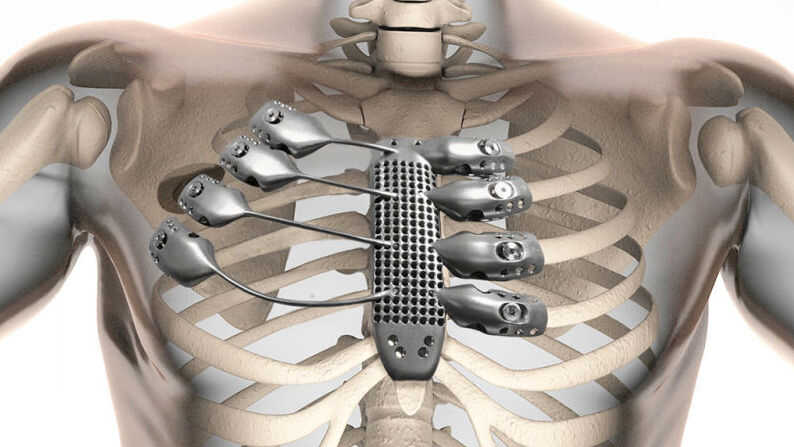 3-D Printer Uses Metal To Make Custom Rib Cage For Cancer Patient