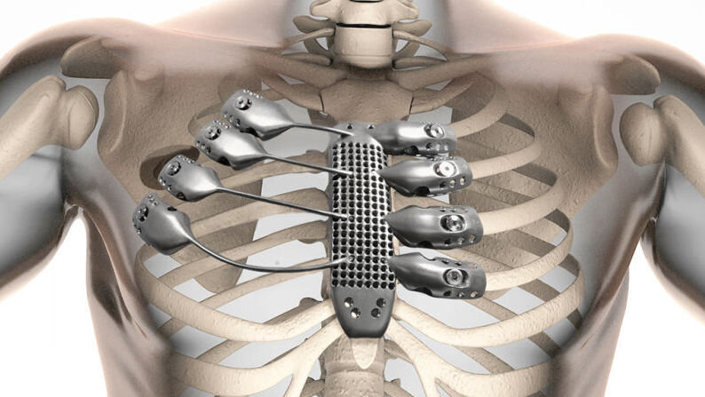 Bone cancer ribs