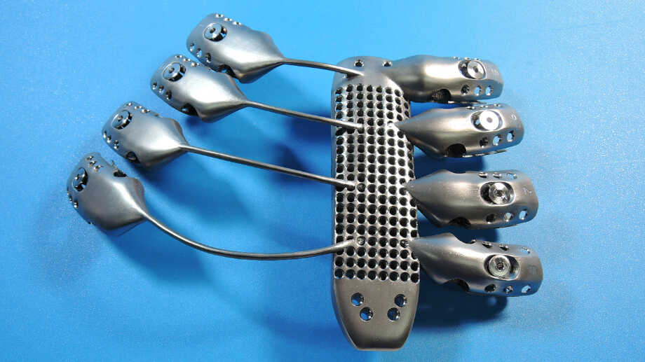 3-D Printer Uses Metal To Make Custom Rib Cage For Cancer Patient