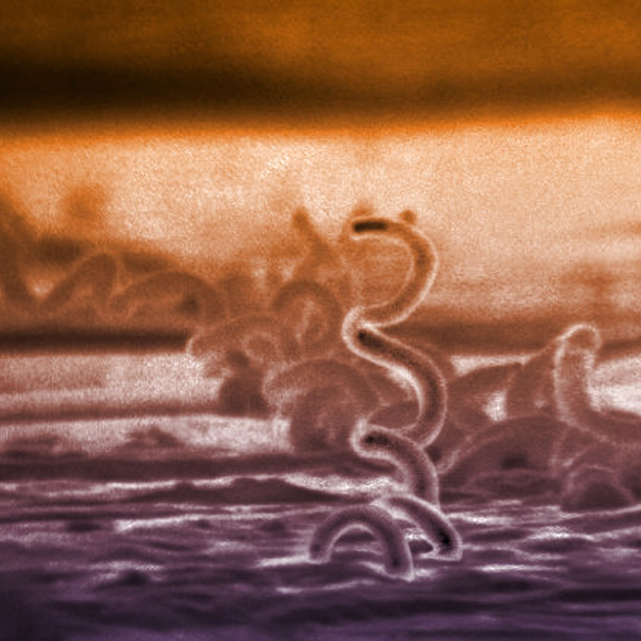 More Babies In The U.S. Are Dying Because Of Congenital Syphilis