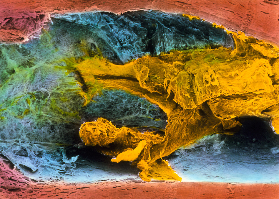 Fatty plaque (shown here in yellow) blocks about 60 percent of this coronary artery's width. The increasing thickness of artery walls is just one factor that can increase vulnerability to a heart attack or stroke. (Prof. P.M. Motta/G. Macchiarelli, S.A. Nottola/Science Source)