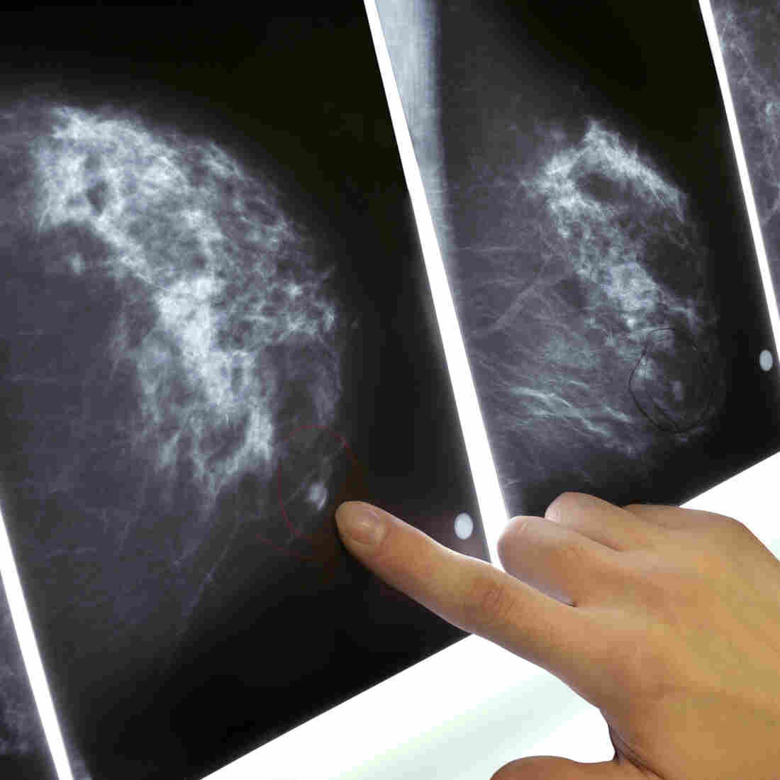 Beyond Mammograms Screening Choices Are Far From Clear Shots 